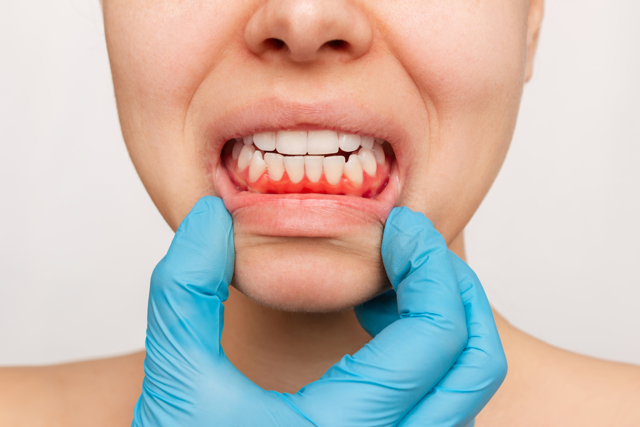 Gum inflammation. Cropped shot of a young woman's face with doctor's hand in a blue glove showing red bleeding gums isolated on a white background. Examination at the dentist. Dentistry, dental care